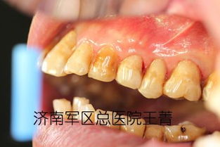 牙齿楔状缺损,不容忽视的 小槽
