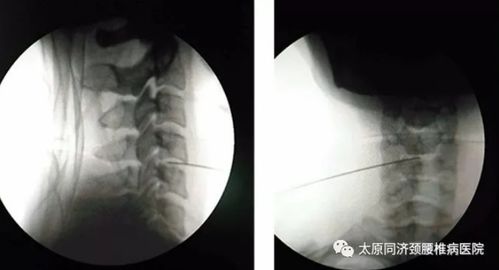太原同济颈腰椎病医院微创案例 射频靶点热凝术治疗混合型颈椎病