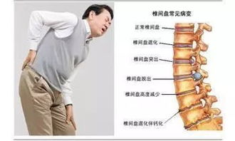 这位阿姨内风湿 骨质增生 腰间盘突出,用了无.限极产品调理好了