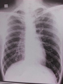 最近胸闷 气短 干一点活就很累 拍了在陶瓷厂上班10年 粉尘多 害怕是矽肺 拍了胸片 这里的医生说