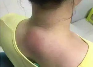 患了颈椎富贵包,肩颈酸痛怎么办 老中医教你一招,一周就能消除