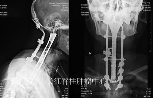 上海长征医院成功切除全球最长节段颈胸段脊柱肿瘤
