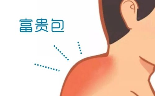 富贵包会给人带来哪些影响 2个复合动作帮你消除富贵包