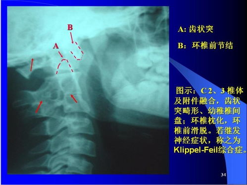 脊椎病的诊断与观片方法