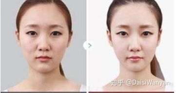 姐姐超声刀做脖子效果图片告诉你超生刀去颈纹效果怎么样