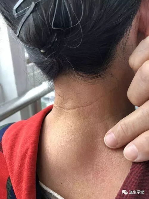颊针疗法 颊针治疗,心身兼顾 一