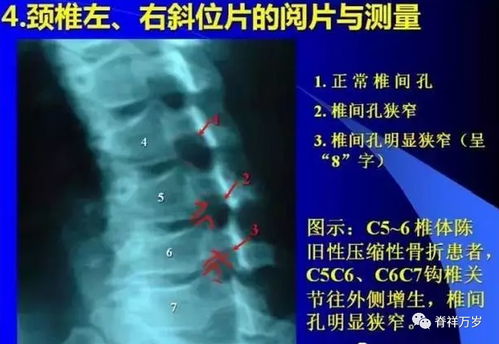 颈椎病 x光片解析