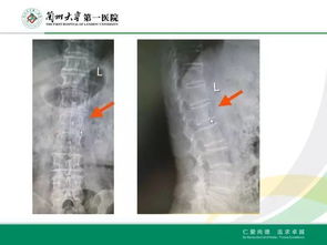 椎体成形术治疗骨质疏松伴腰椎病理性骨折