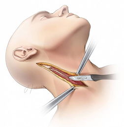 颈动脉内膜剥脱策略与技巧 carotid endarterectomy 丨the neurosurgical atlas全文翻译