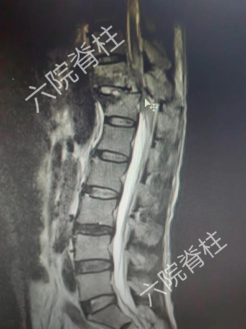 颈胸腰椎严重骨折脱位.