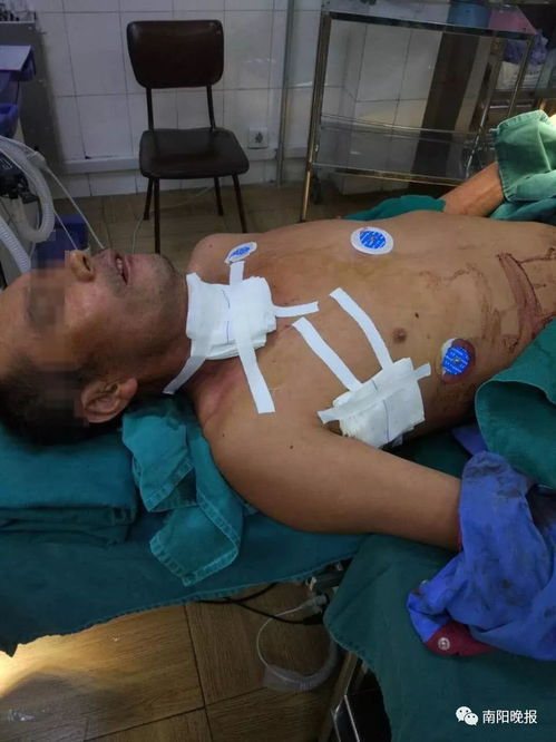 心理素质差的不要点进来 南阳一男子遭80厘米长钢筋穿过胸 颈 口腔 发生了什么