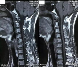 神经根型颈椎病保守治疗的比较