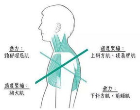 圆肩 驼背 头前引 上交叉综合症的肌动学基础及处理策略
