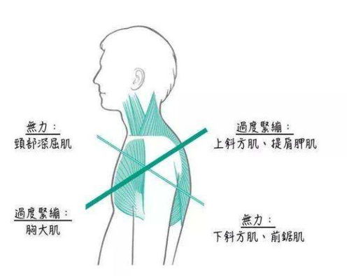含胸 驼背 颈肩痛,自查预防 上交叉综合征
