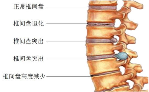 一生不得颈腰椎病