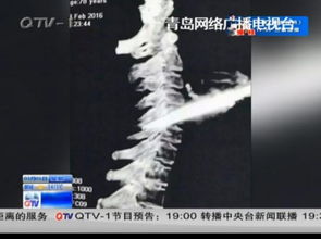 78岁老太走路被绊倒致手中剪刀插入脖颈 图