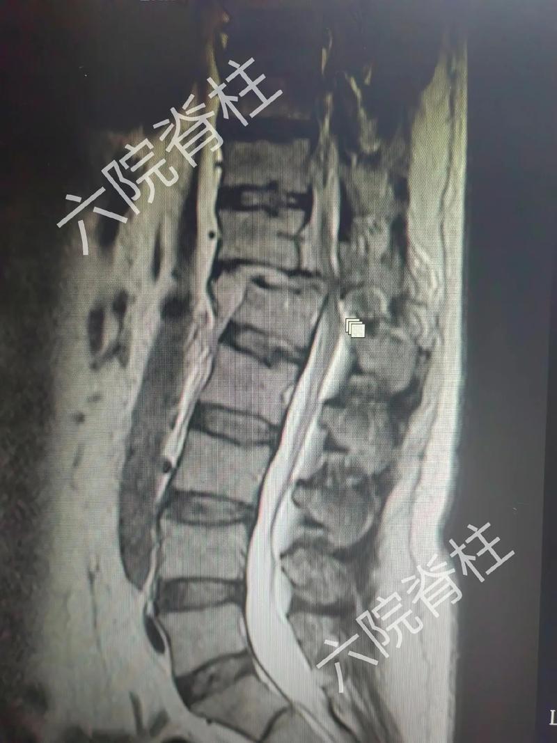 颈胸腰椎严重骨折脱位.