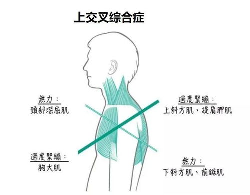 中小体重基数人群的减肥塑形指南：避开误区，守护颈椎健康
